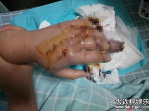 深圳一女子电梯中突遭持刀抢劫被砍二十余刀 两根手指被砍断